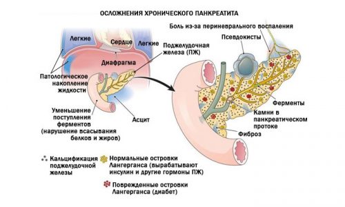 Панкреатит у мужчин имеет опасные последствия, которые способны привести к летальному исходу