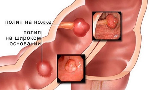 Полипы в поджелудочной железе – это доброкачественные новообразования, которые имеют тенденцию к злокачественному перерождению