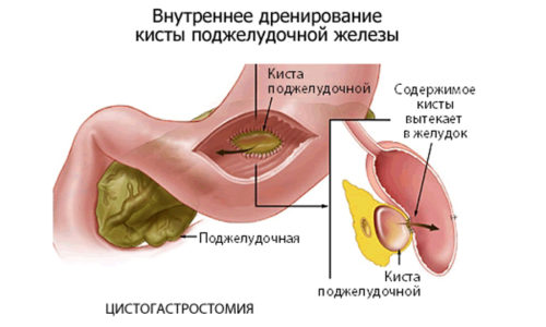 Устранение новообразования может осуществляться таким малоинвазивным методом как внутреннее дренирование