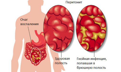 При отсутствии лечения заболевание может осложняться перитонитом