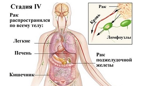 Эта стадия рака головки железы считается безнадежной, т.к. метастазы обнаруживаются не только в близлежащих, но и отдаленных органах