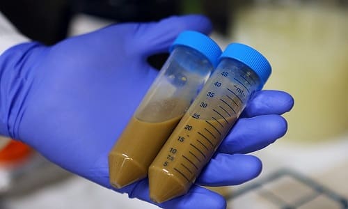 Определение уровня эластазы в каловых массах используется для подтверждения диагнозов опухолей и воспаления железы, непереносимости лактозы и других болезней